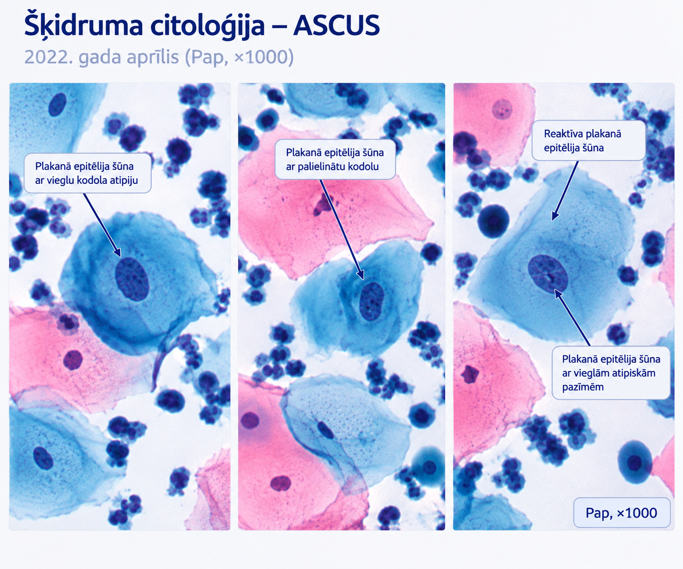 Citoloija - ASCUS